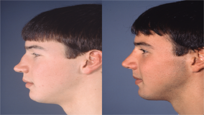 Сон нос мужчины. Седловидный нос ринопластика. Нос с горбинкой в профиль мужской.
