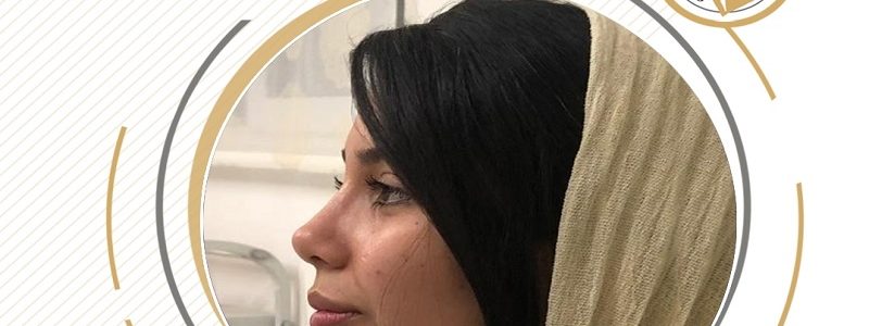 نمونه جراحی بینی طبیعی زنانه