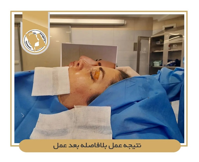 جراح بینی اصفهان | نتیجه عمل بلافاصله بعد از عمل