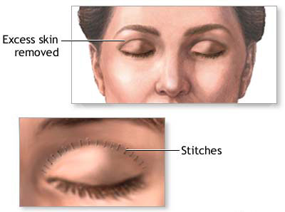 Prevention of aging and drooping eyelids