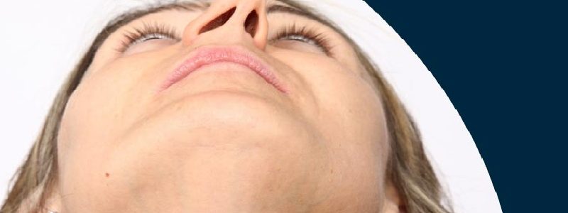 7 signes importants pour diagnostiquer une déviation nasale
