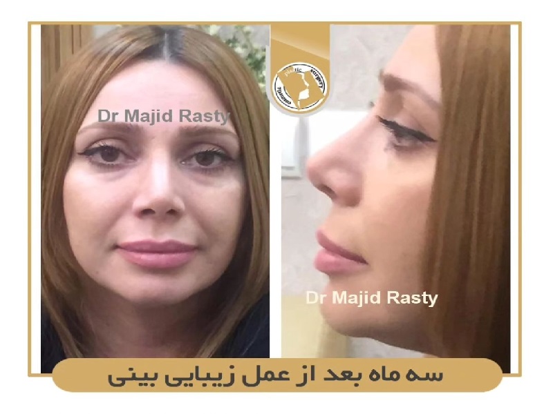 جراح بینی اصفهان | نتیجه جراحی زیبایی بینی بعد از سه ماه 