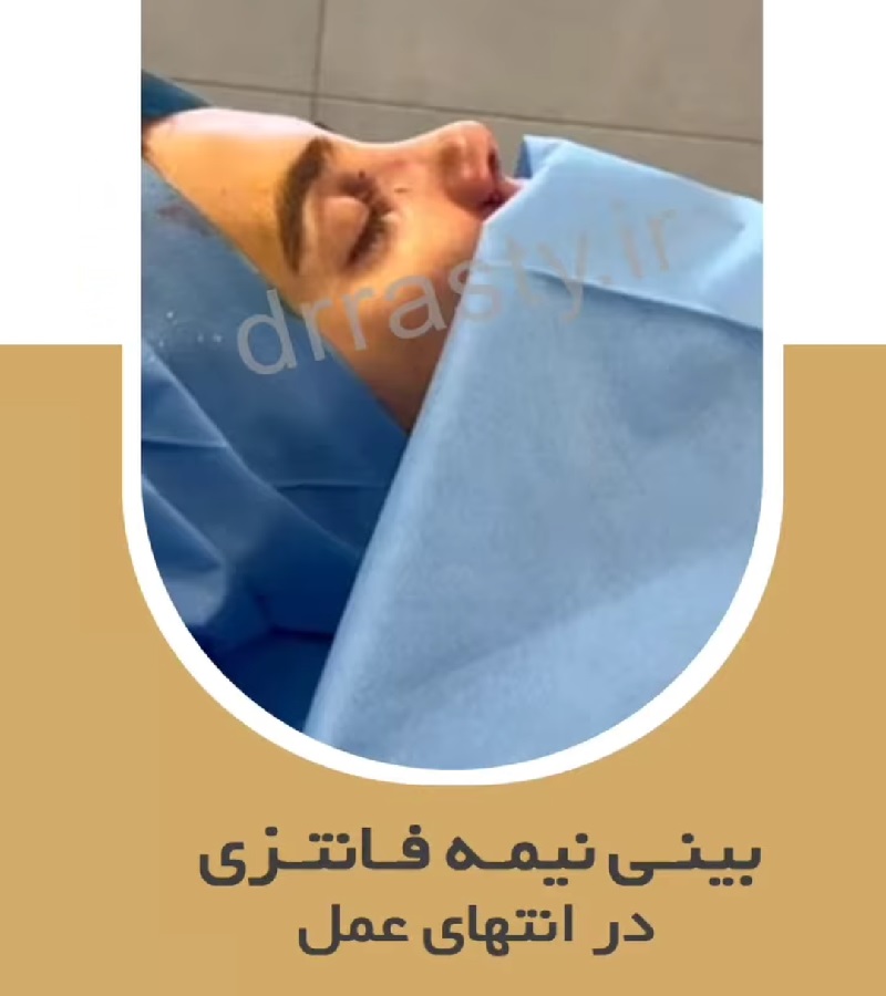 Of nose surgery | Rhinoplasty Isfahan | Semi-fantasy surgery result at the end of the operation