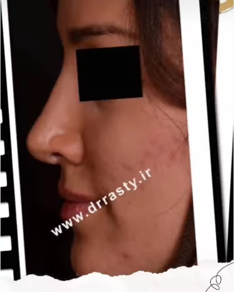 Of nose surgery | Rhinoplasty Isfahan | Pictures before and after surgery by Dr. Majid Rasti