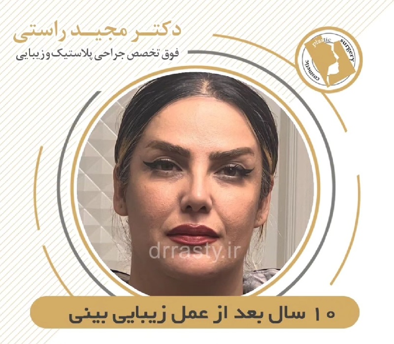 Of nose surgery | Rhinoplasty Isfahan | 10 A year after rhinoplasty