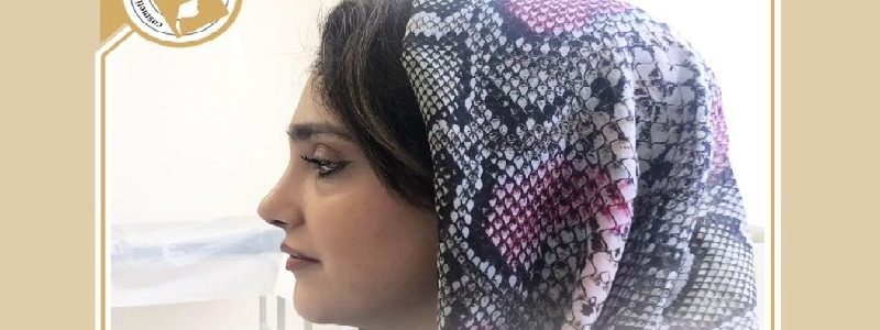 نتيجة عملية تجميل الأنف بعد سنة من العملية