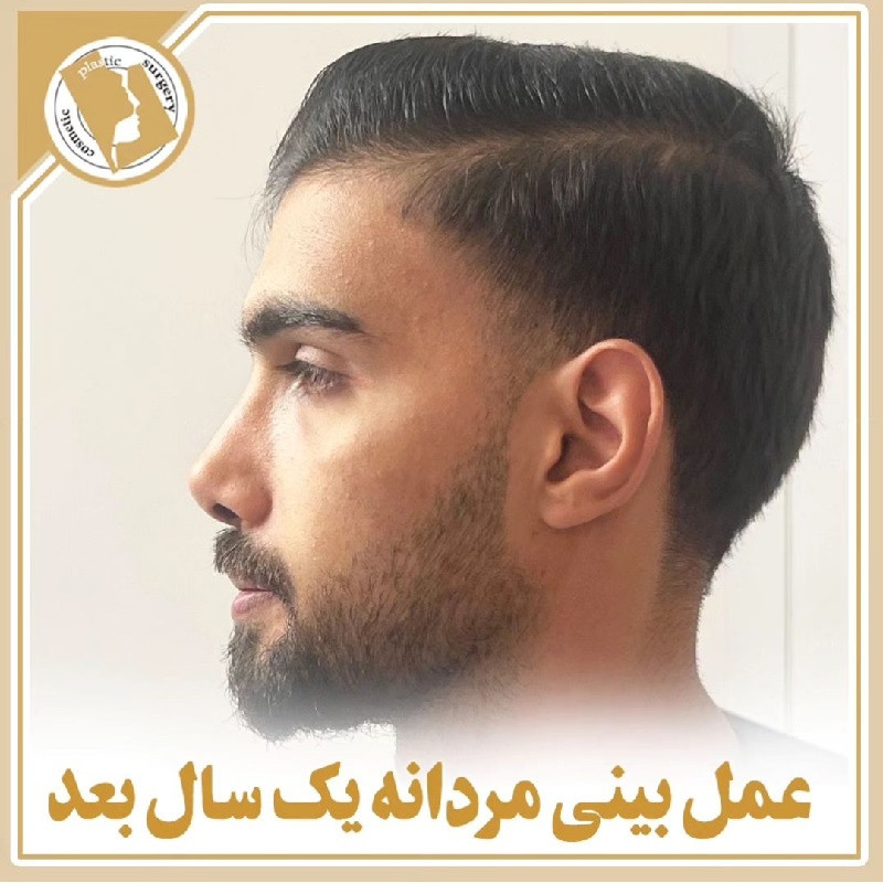 Of nose surgery | Rhinoplasty Isfahan | Male nose job