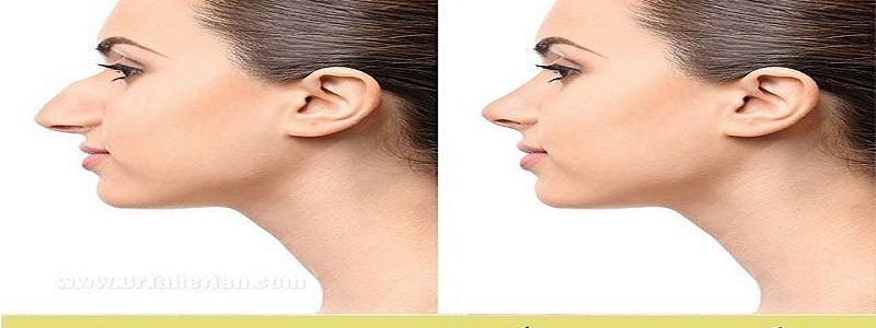 The best type of nasal hump surgery