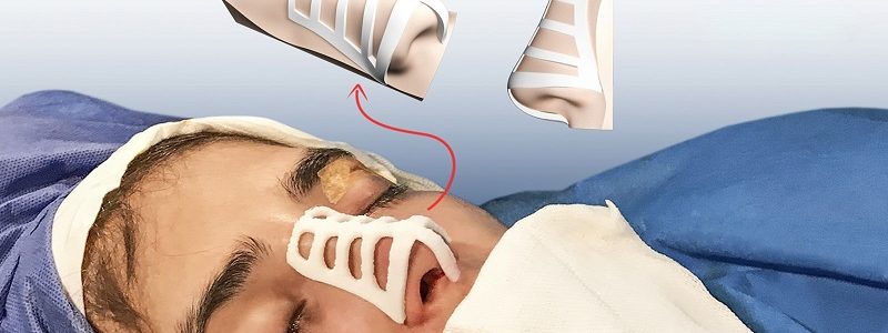 جراحی بینی با قالب کنترلی