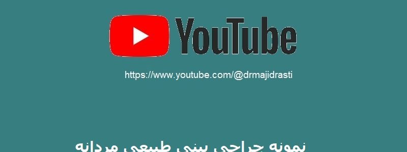 مثال على جراحة أنف الذكور العادية