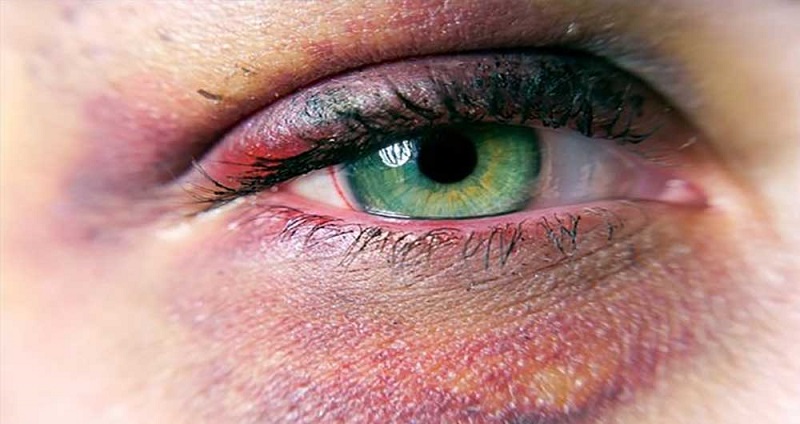 جراح بینی اصفهان | علت به وجود آمدن کبودی زیر چشم بعد از عمل زیبایی بینی