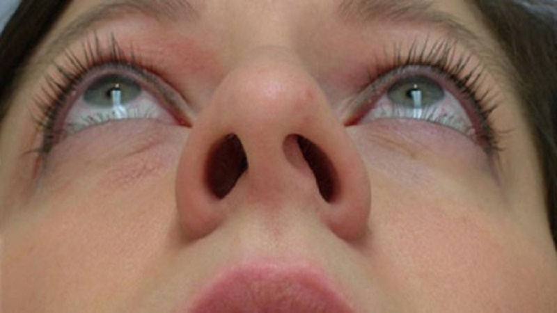 Of nose surgery | Shrink nostrils
